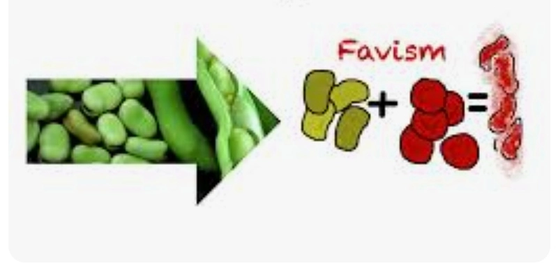 صورة لتكسير كريات الدم الحمراء عند تناول البقوليات لدى المصابين بمرض أنيميا الفول.