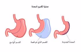 تكميم المعدة ما بين الفوائد والمخاطر.. كل ما تريد معرفته عن هذه العملية الشائكة