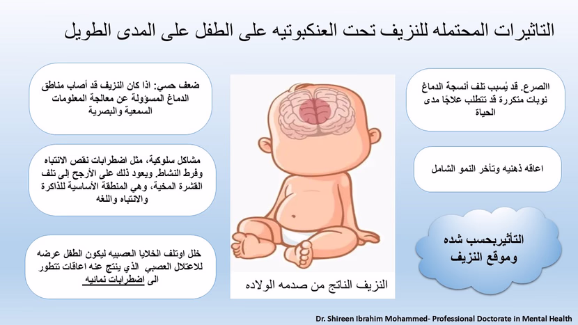 النزيف تحت العنكبوتيه ألناتج من صدمه الولاده, وأخطر اثاره على المدى البعيد