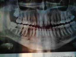 ماهو خراج الأسنان وكيف يُعالج