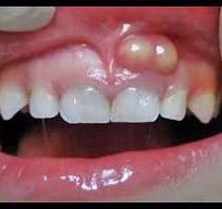 ماهو خراج الأسنان وكيف يُعالج